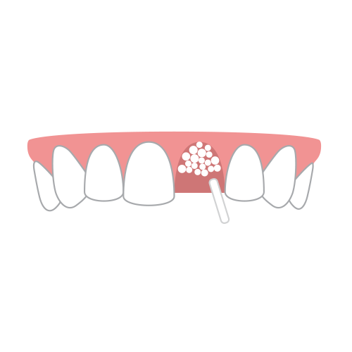 BONE GRAFT