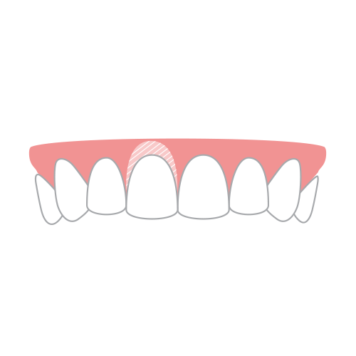 SOFT TISSUE GRAFT